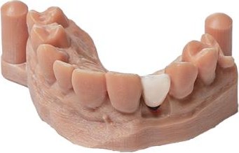 Anterior restorations